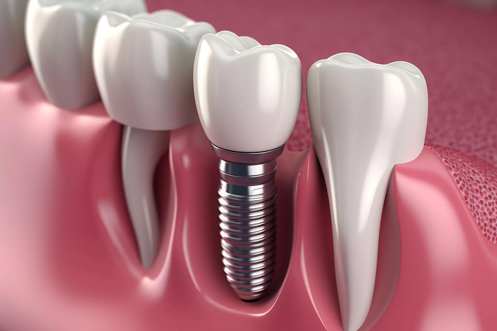 Dental Implants